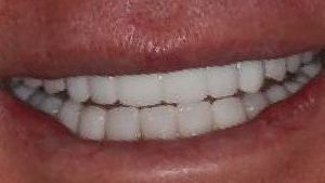 After smile makeover