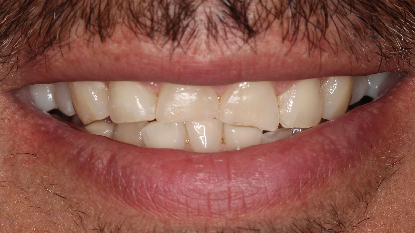 Before smile makeover