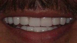 After smile makeover