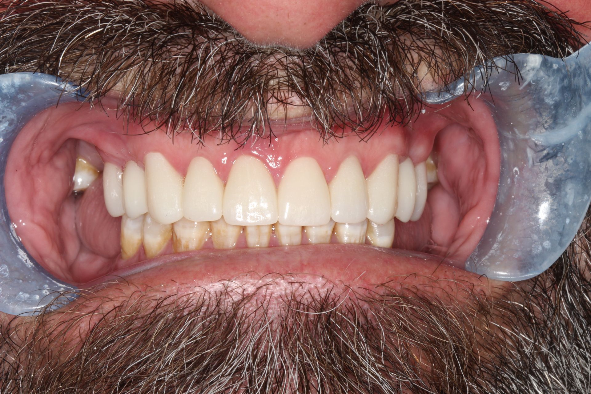 After smile makeover