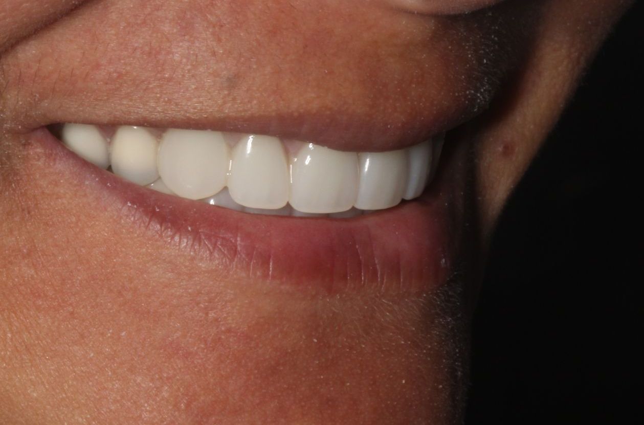 After snap on dentures