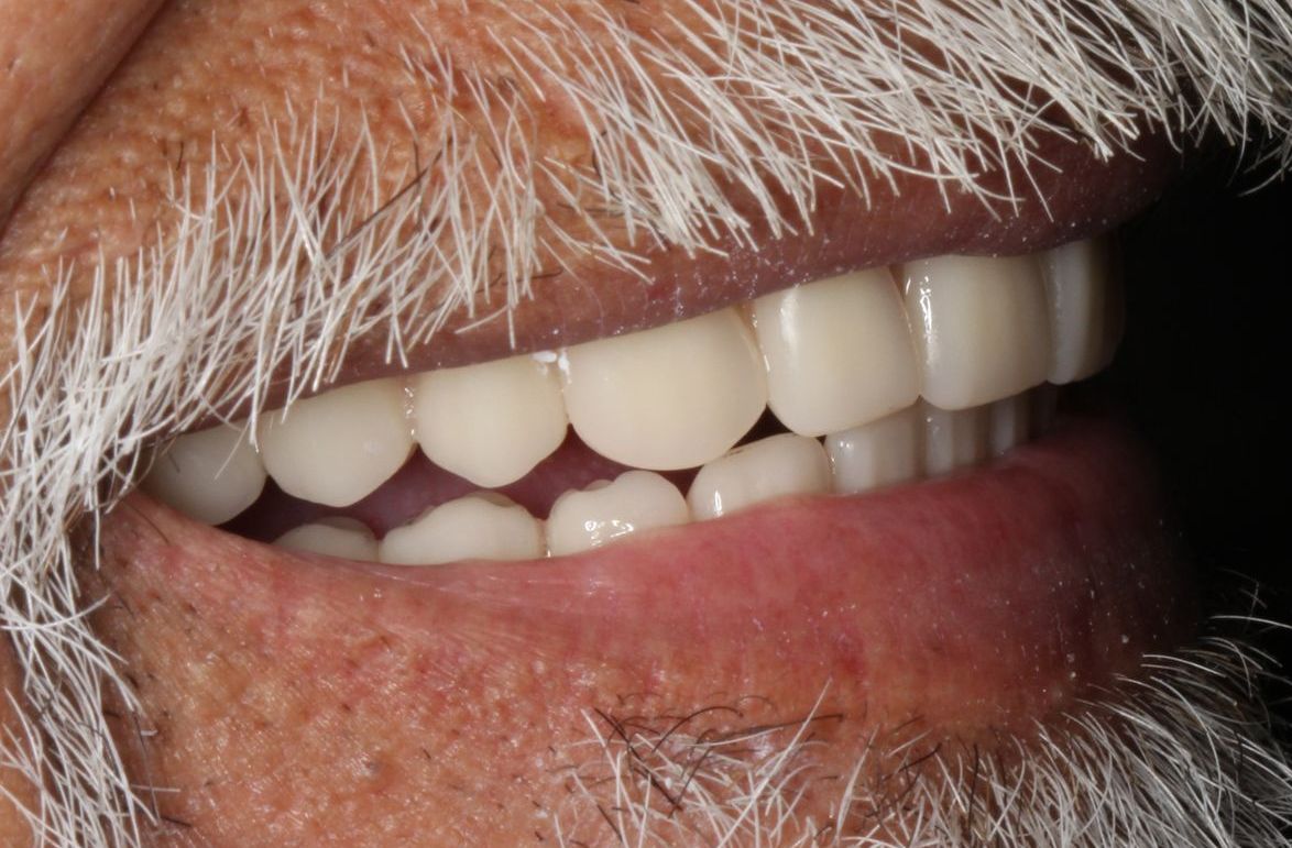 After snap on dentures