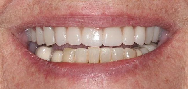 After snap on dentures