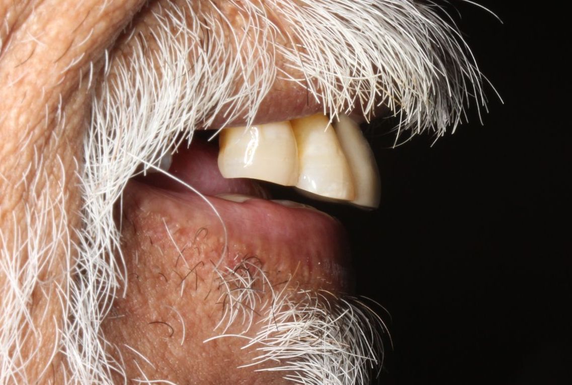 Before snap on dentures