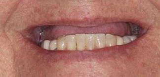 Before snap on dentures
