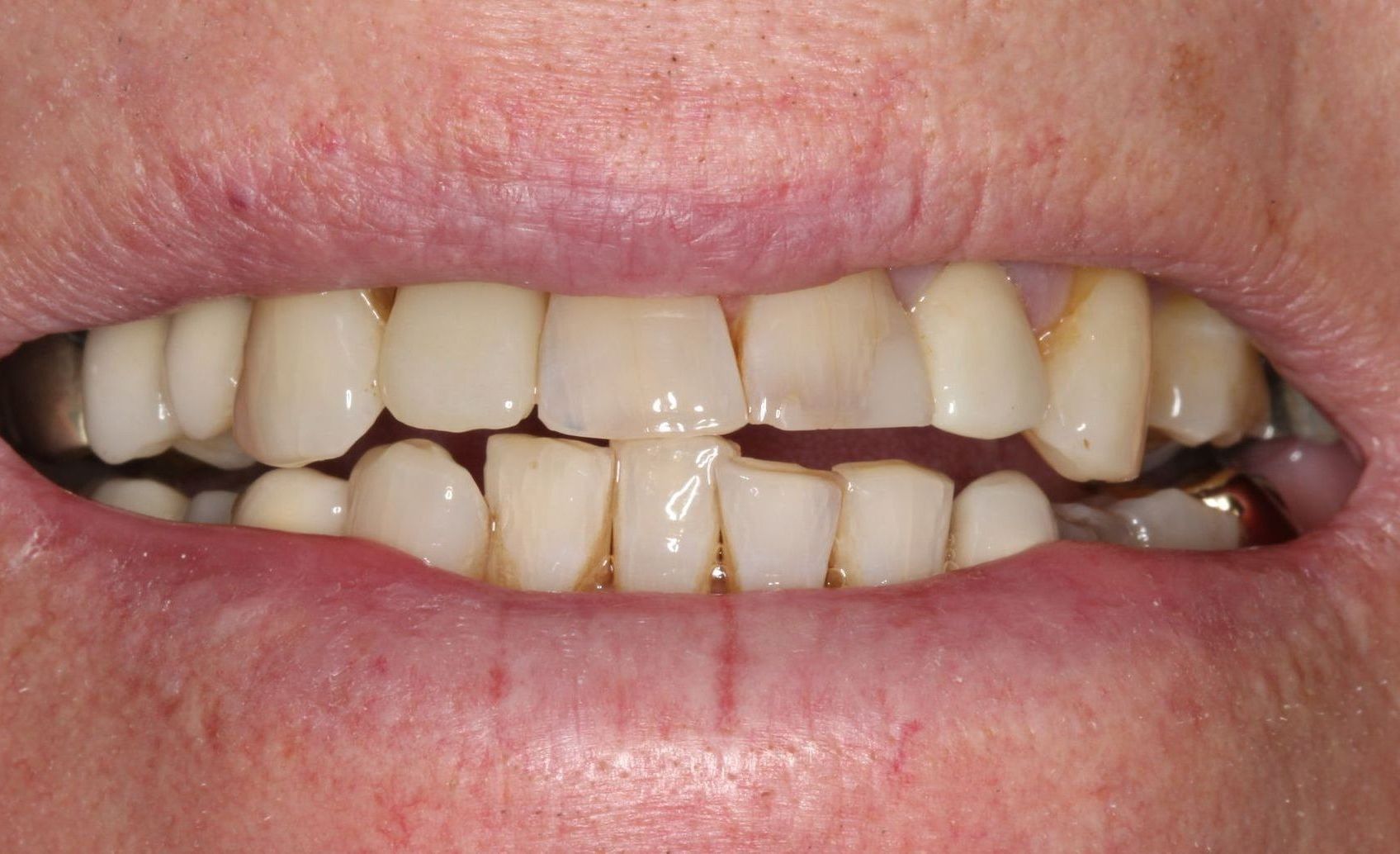 After Single Implants