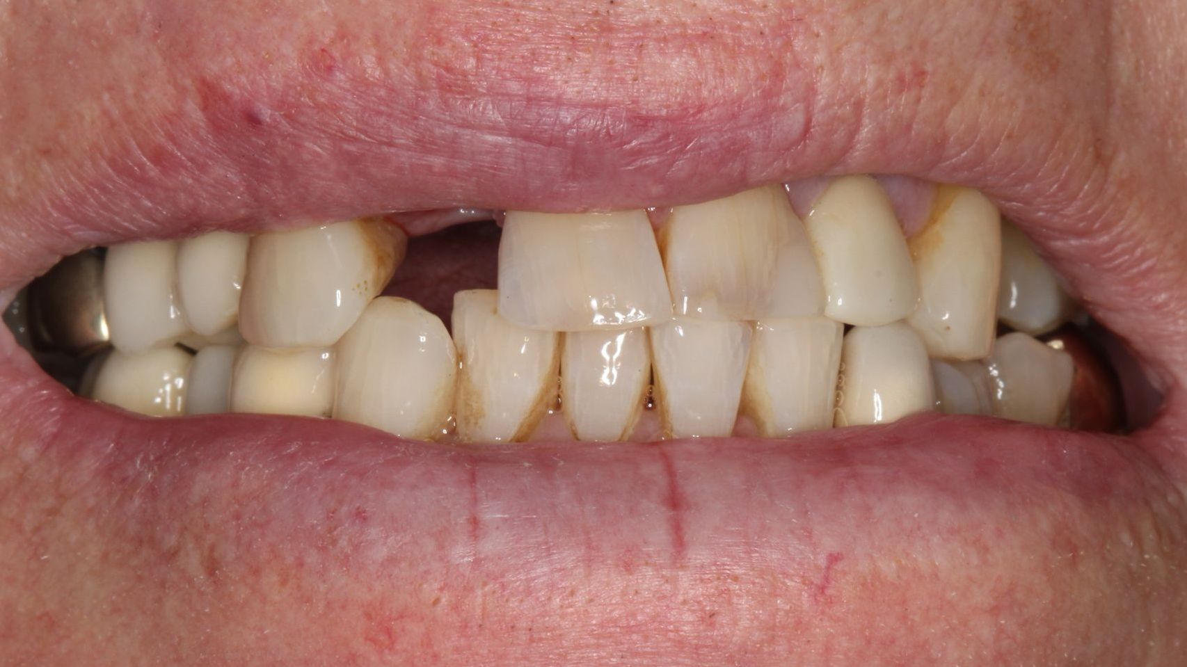Before Single Implants