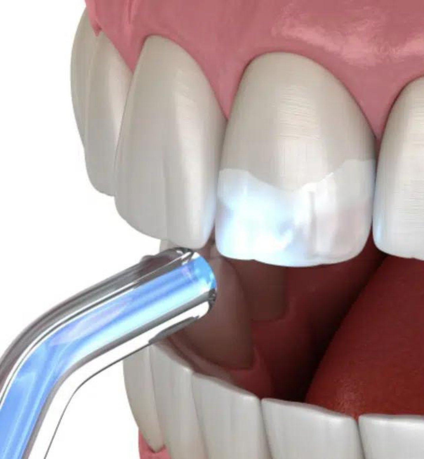 Dental Bonding