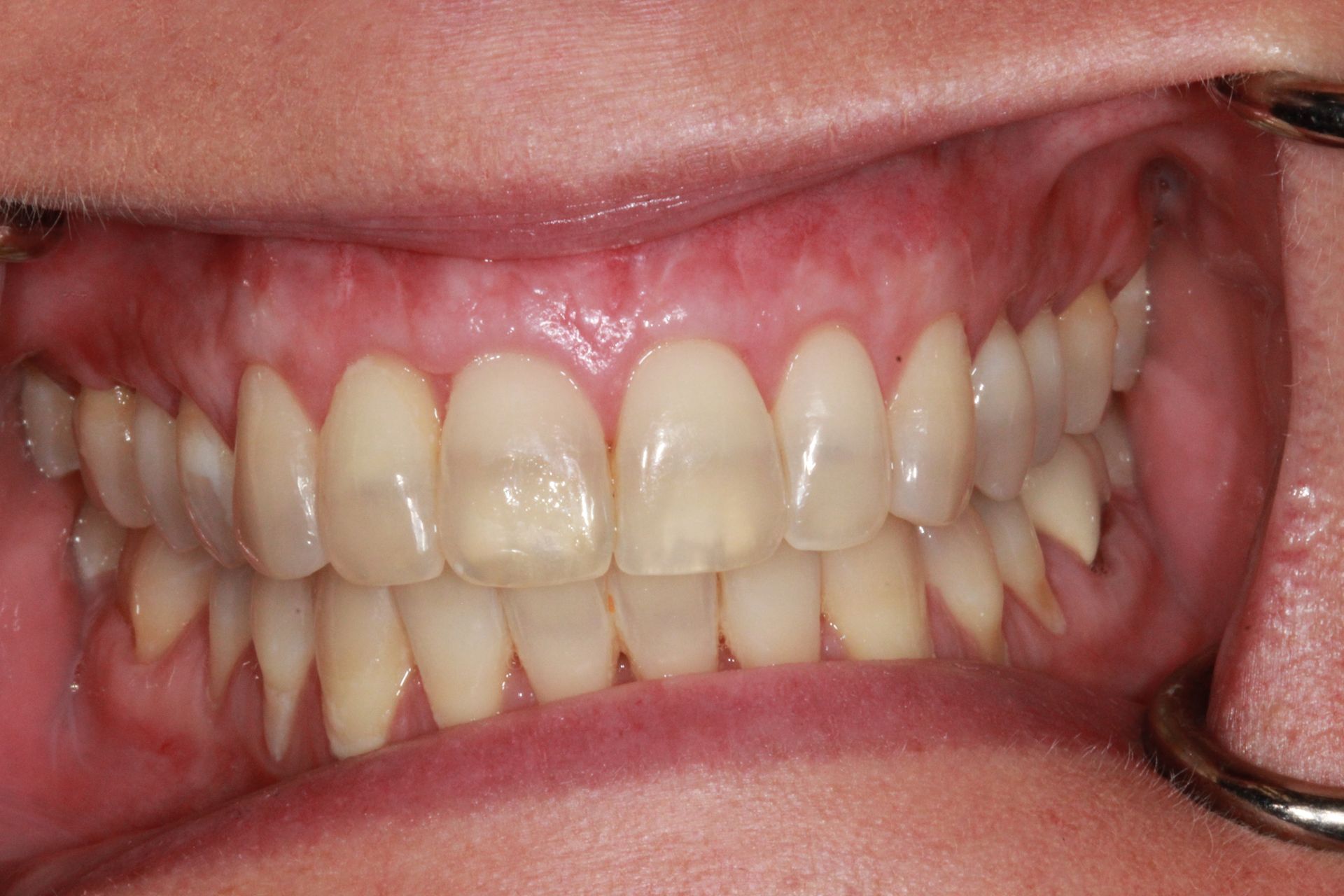 gum grafting after | Best cosmetic dentist in Corpus Christi 78404