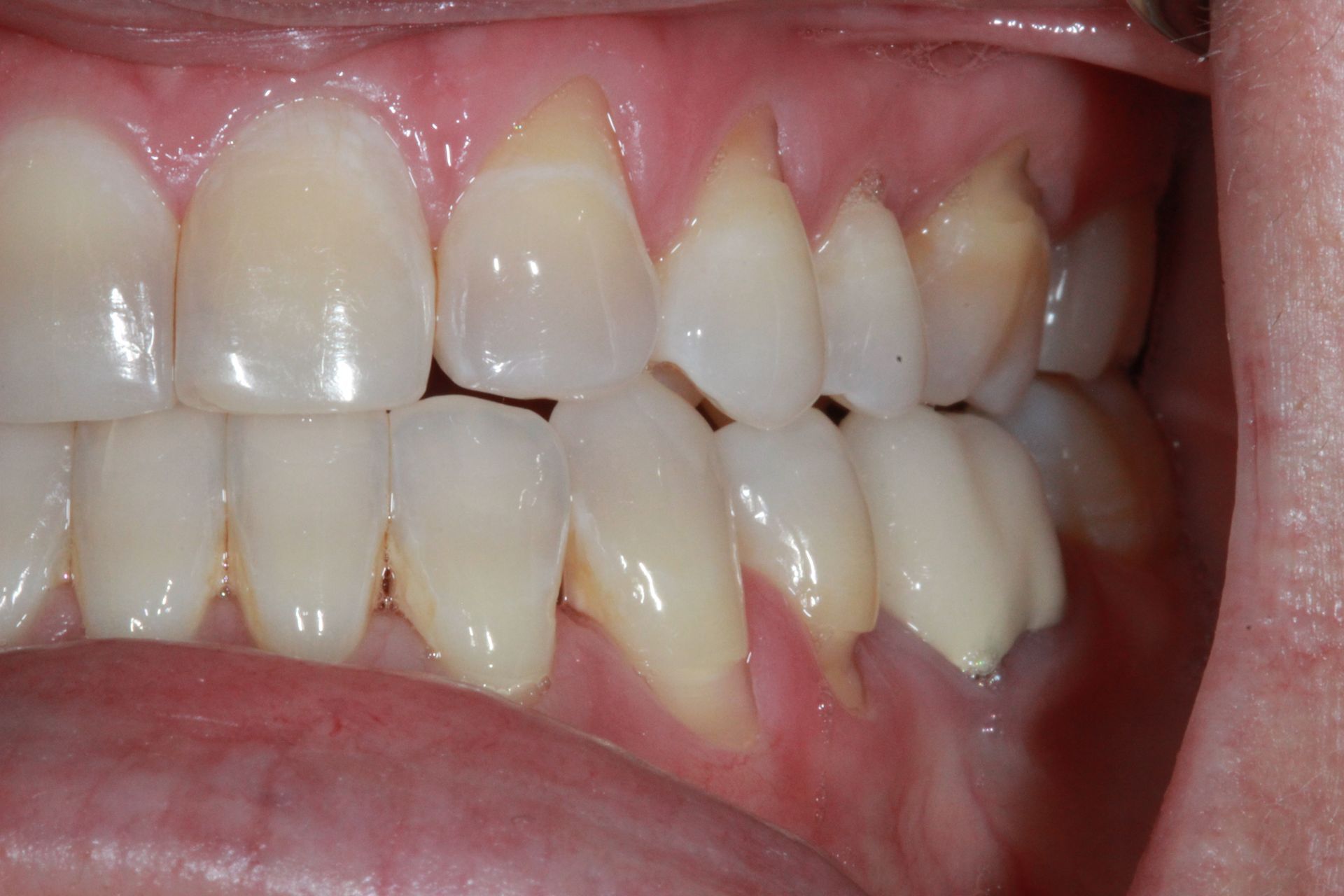 Before Gum Grafting