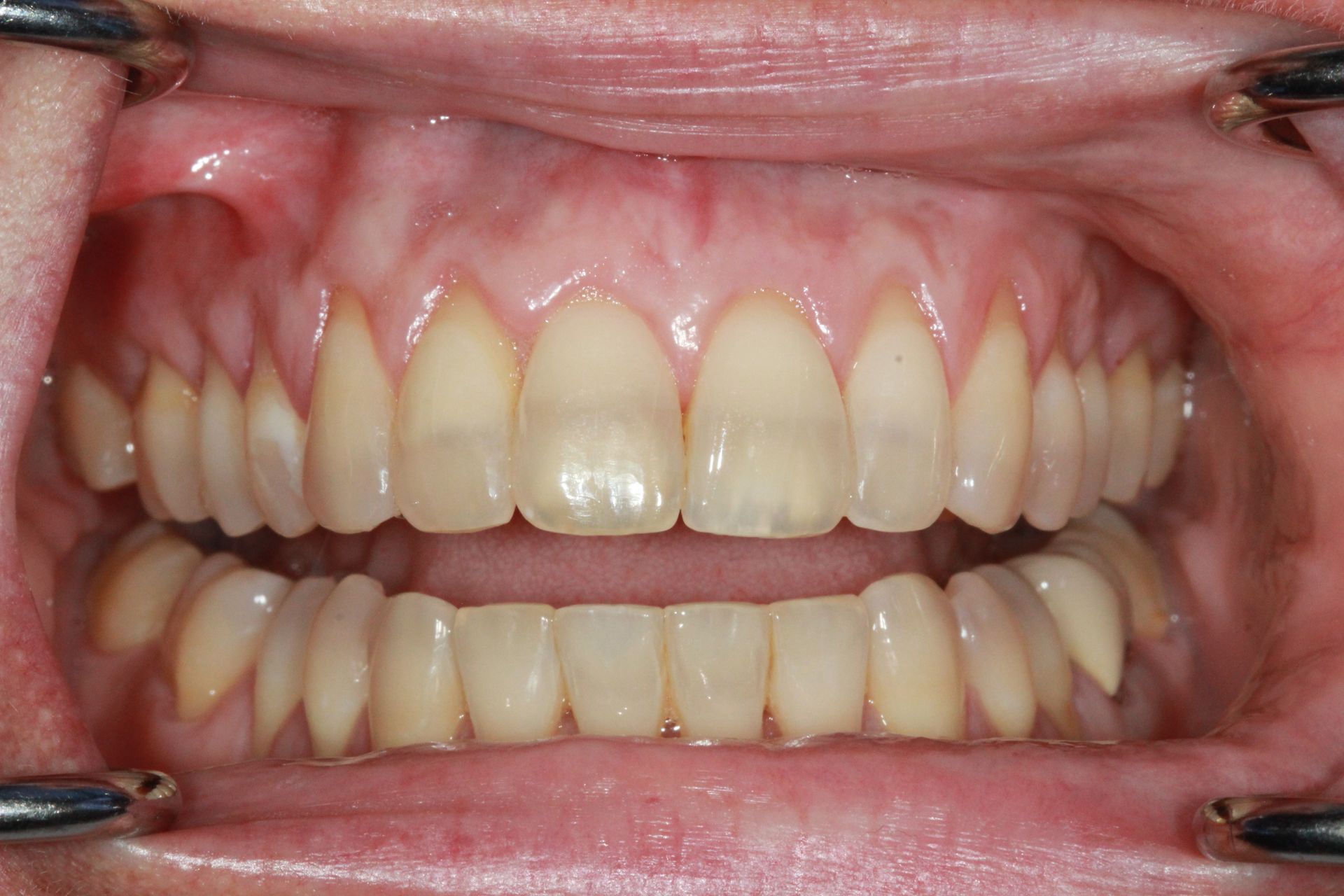 gum grafting | Top restorative dentist in Corpus Christi tx 78404