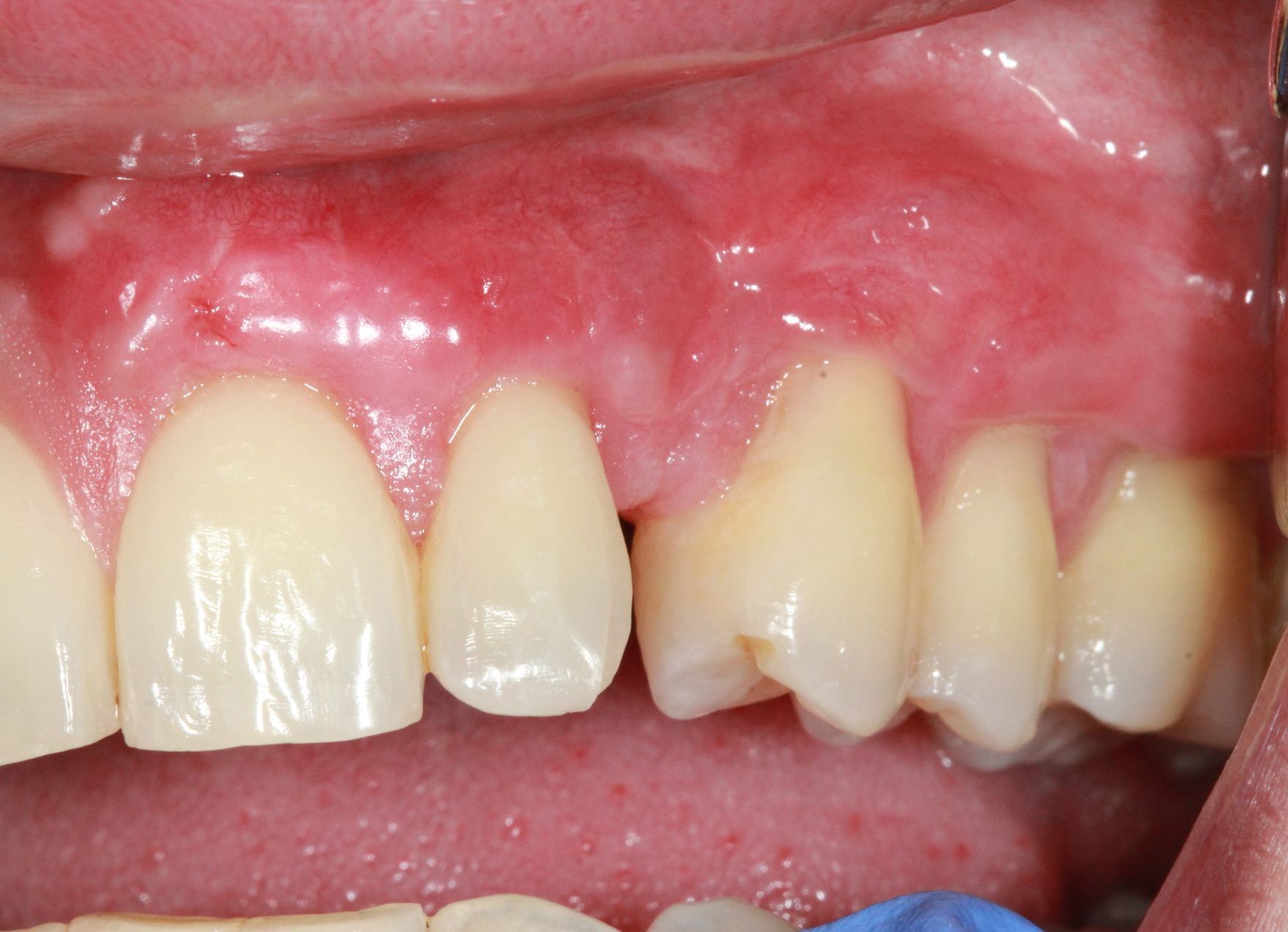 After Gum Grafting