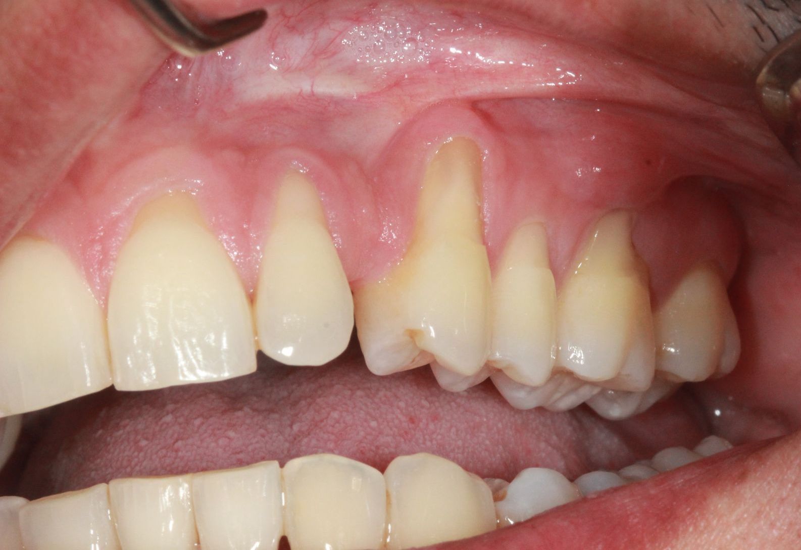 Before Gum Grafting