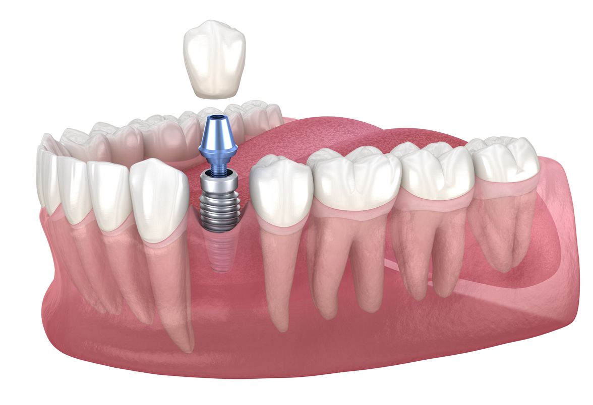 Single Implants