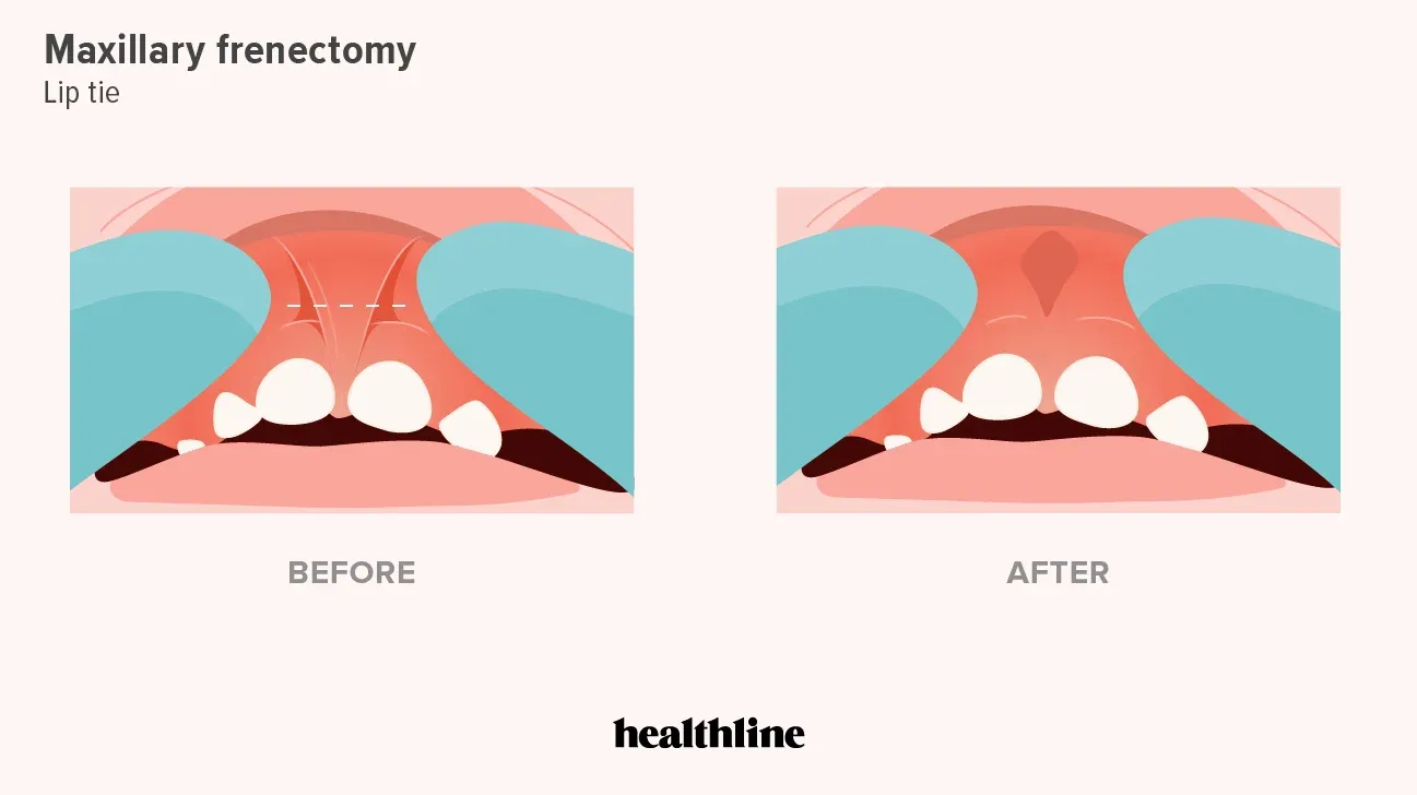 frenectomy Before and after