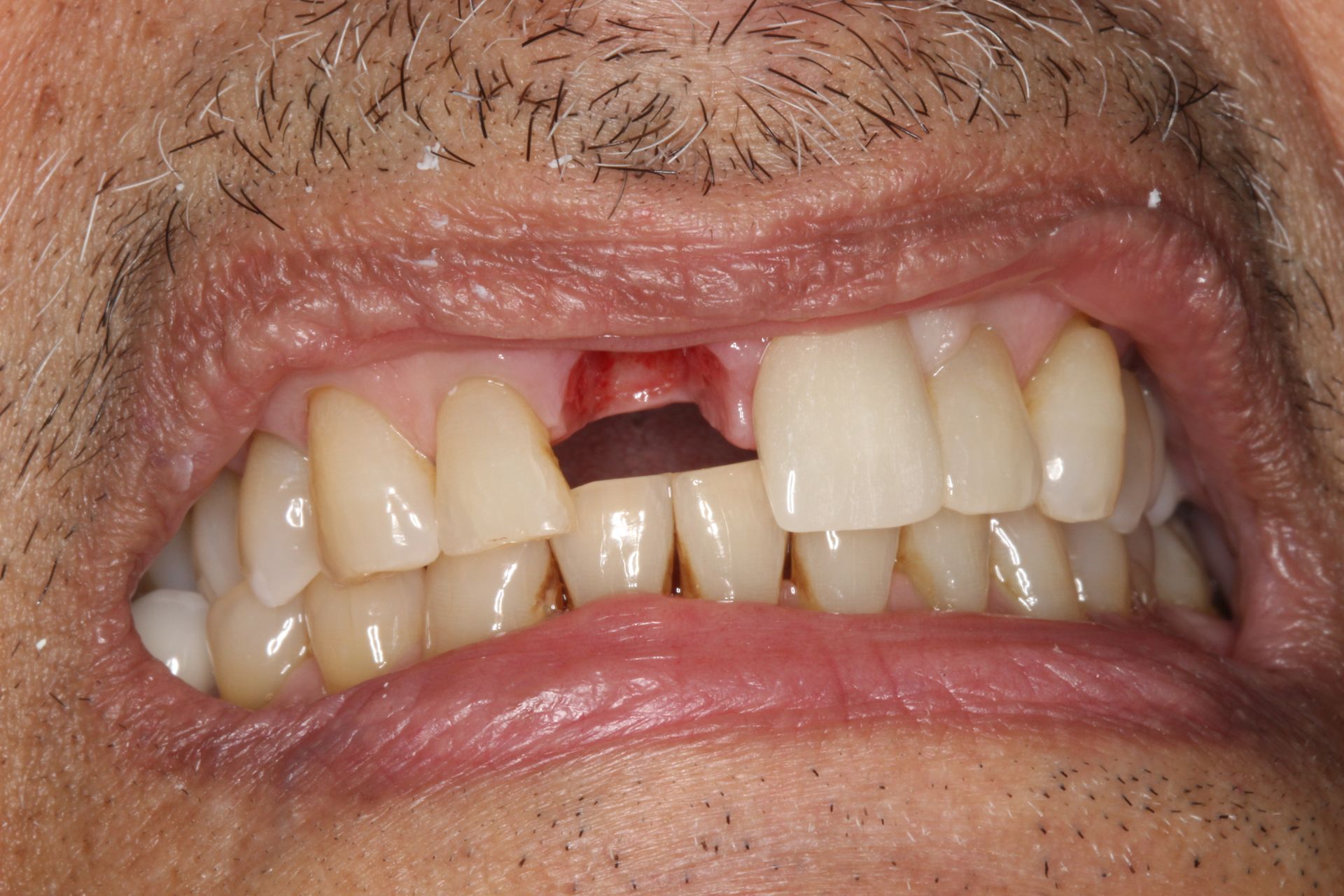 Before Single Implants