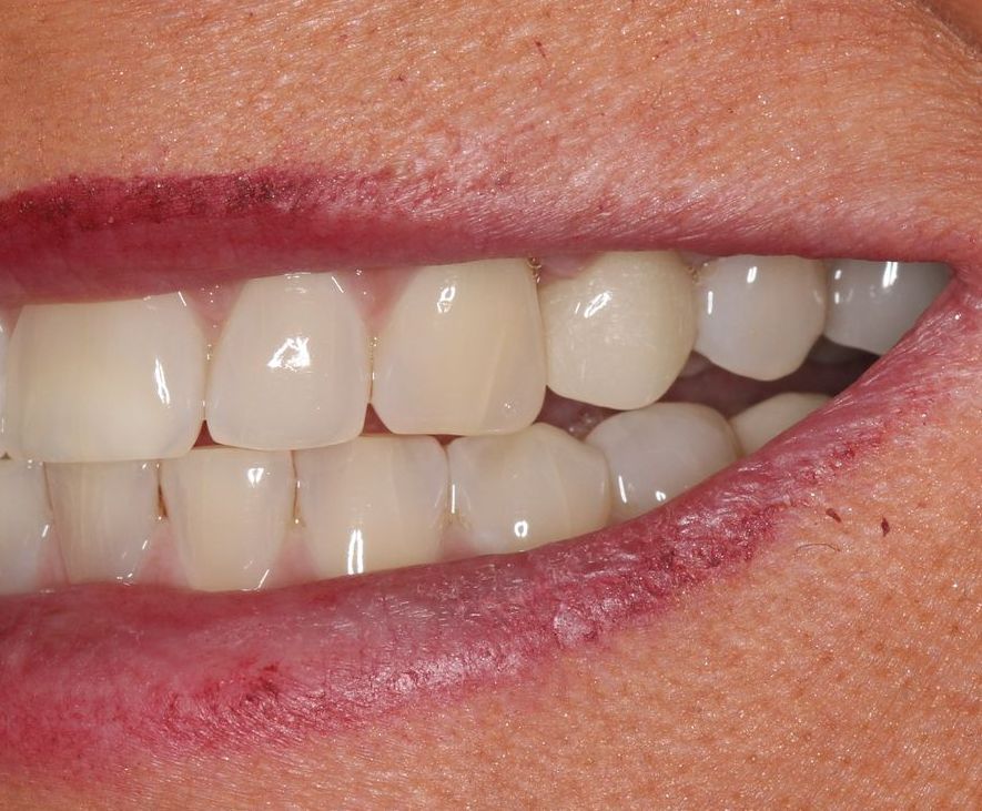 After Single Implants