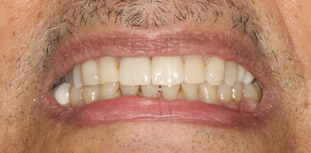 After Single Implants