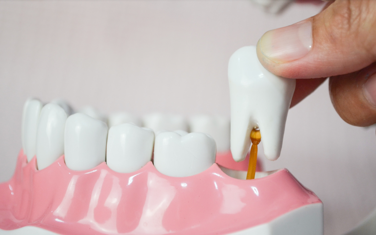 showing wisdom teeth extraction process | Corpus Christi 78404