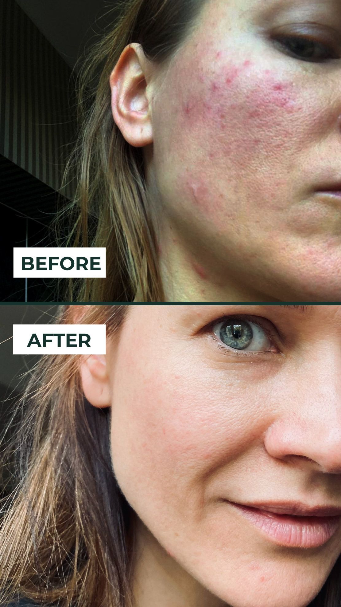 Huidproblemen; rosacea, eczeem, psoriasis, acne Huidwijzheid bij Lijfwijz Twente