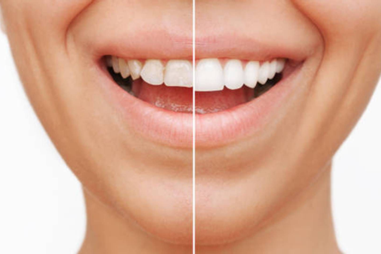 A split-screen comparison showing teeth before and after whitening, with the right side appearing whiter and brighter.