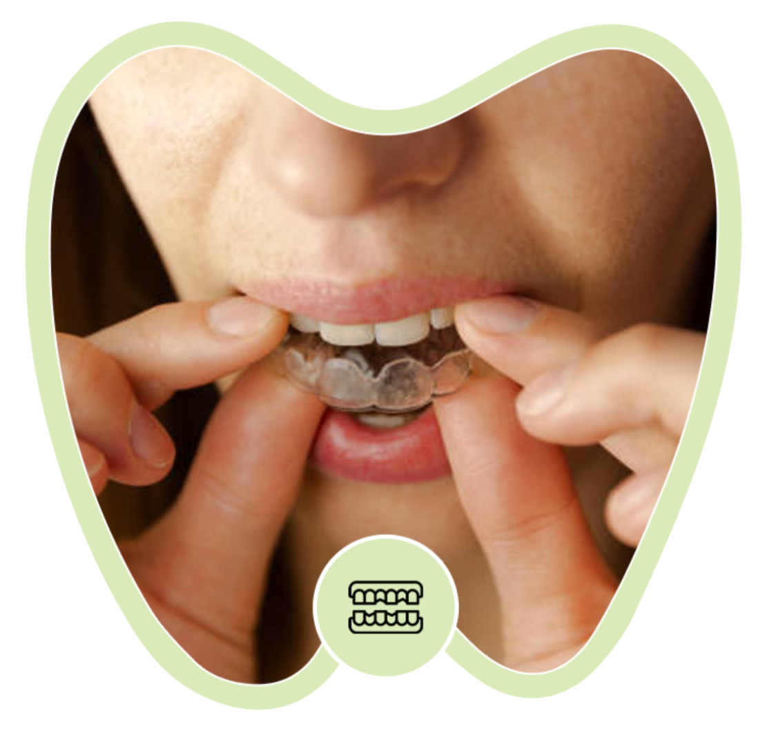 A person using both hands to place a clear plastic dental aligner over their bottom teeth.
