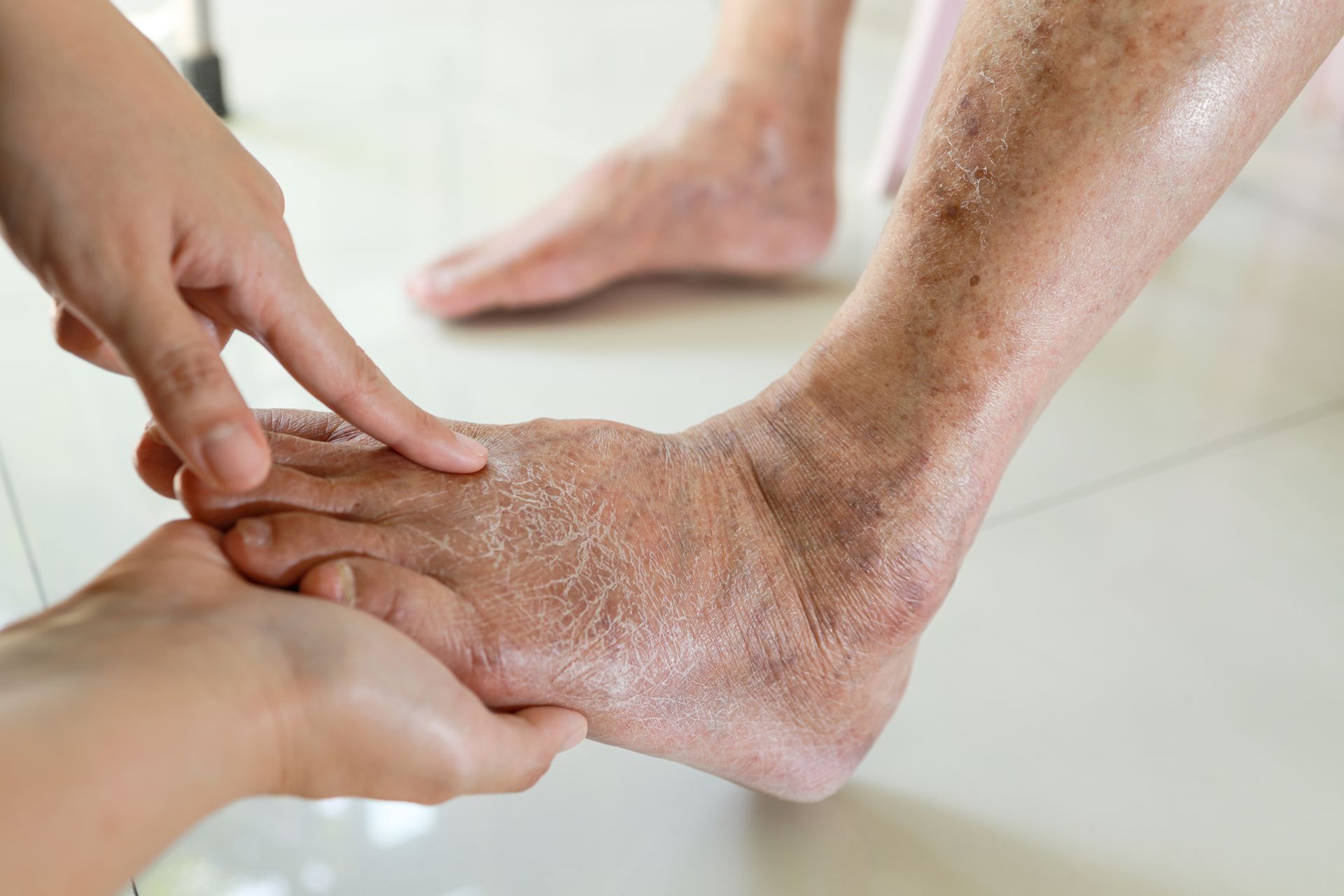 A person's swollen foot being examined by another person's hand.