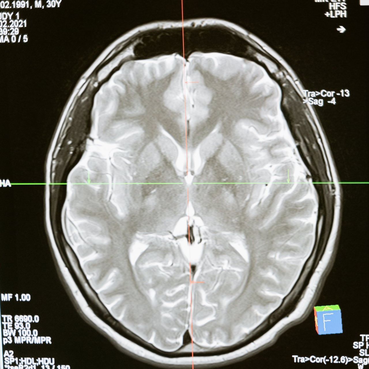 brain scan