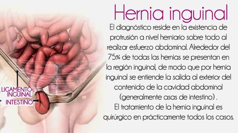 DR. SERGIO U. ACOLTZI ESCORCIA - HERNIA HINGUINAL