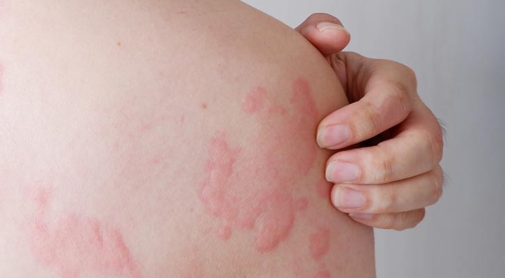 Alpha-gal Syndrome Treatments NYC by Marc Bystock L.Ac.