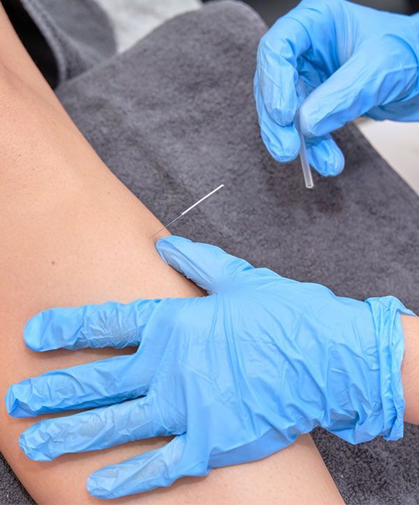 A person wearing blue gloves is getting an acupuncture treatment on their arm. How Does Acupuncture Treat Hypertension?