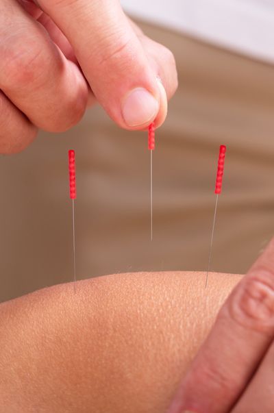 Acupuncture for Knee Pain
