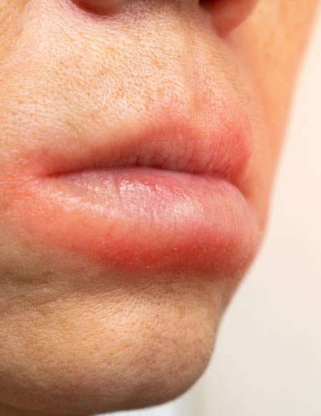 Treatments for Allergic Reactions Natural Allergy Remedies by Marc Bystock NYC Acupuncturist in Midtown Manhattan NY 10016