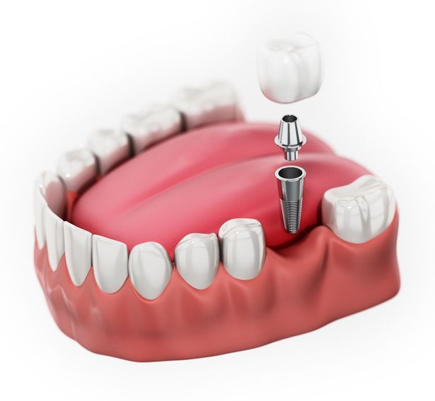 Dental implant components—implant, abutment, and crown—shown hovering above a gap in a human lower jaw model.