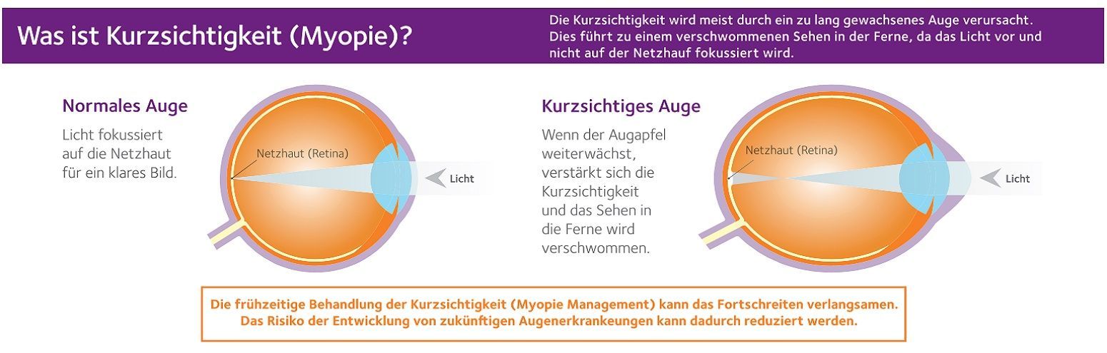 Ein Diagramm eines normalen Auges und eines Auges mit Kurzsichtigkeit.