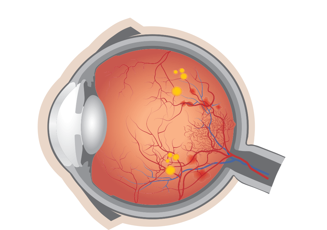 Diabetische Retinopathie