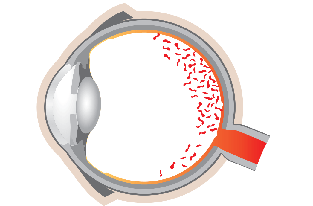 Retinopathia Pigmentosa