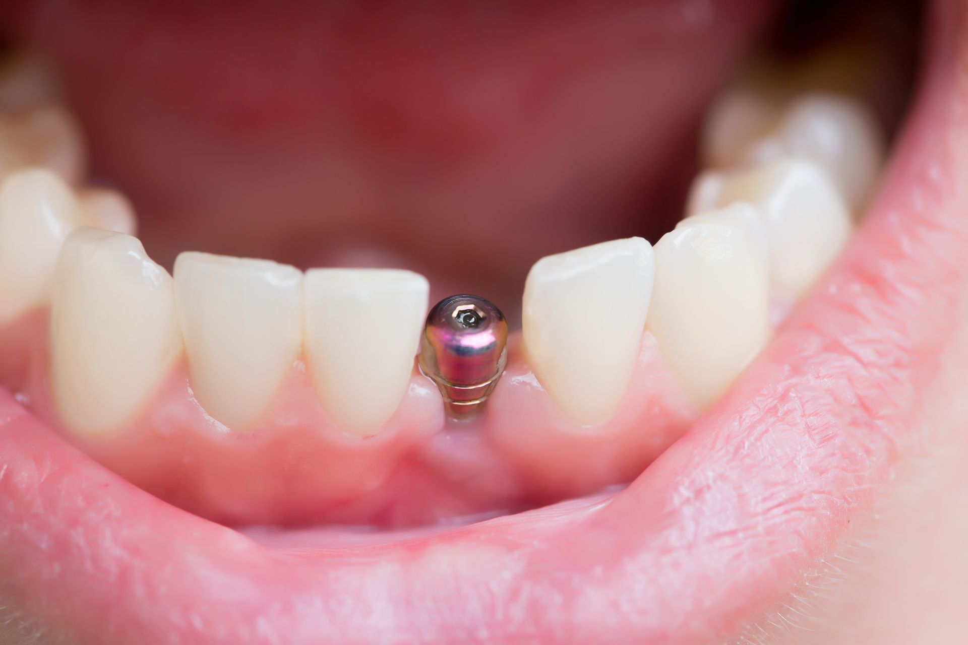 Dental implants abutment placed in the lower front jaw between natural teeth Dental implants abutment placed in the lower front jaw between natural teeth