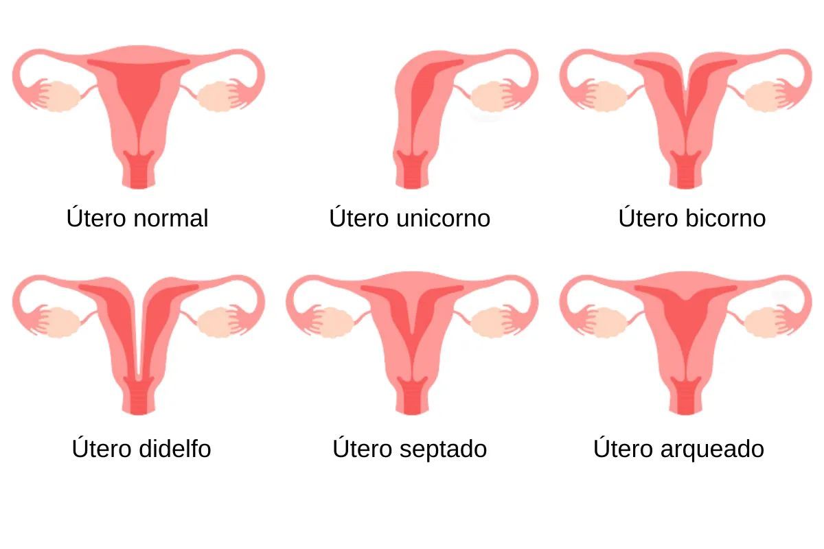 malformacoes-uterinas-tipos-dra-camila-poccetti-ginecologista-sao-paulo