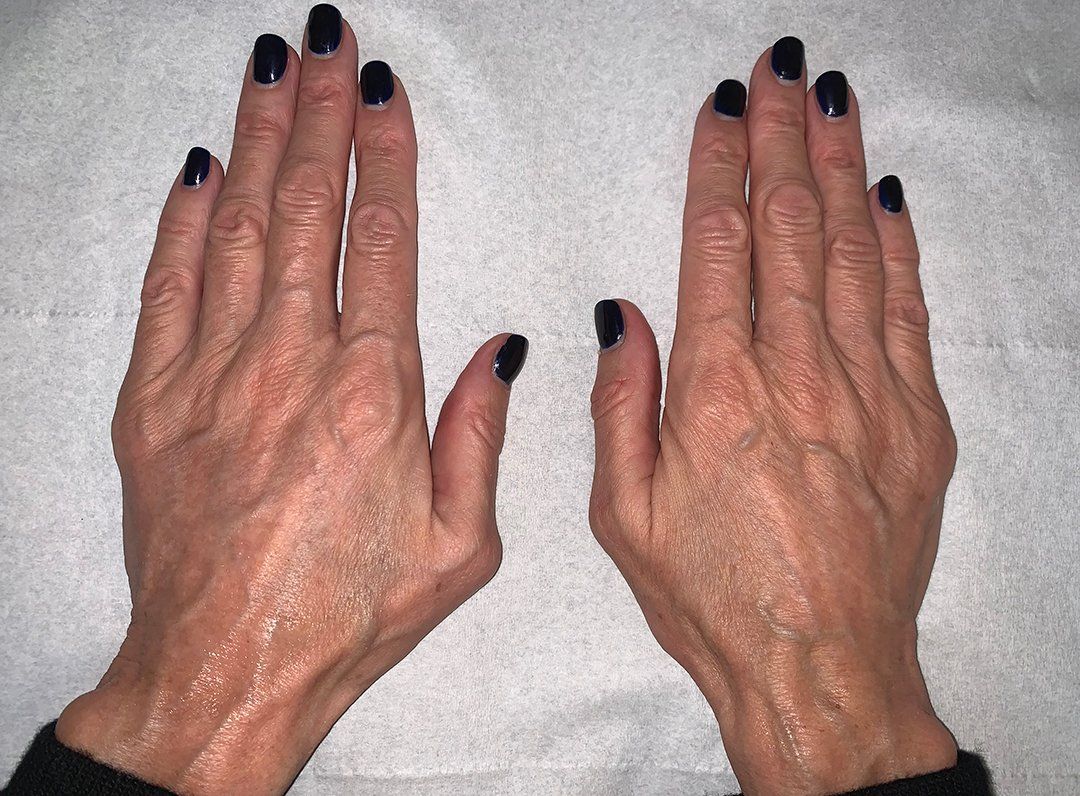 Hand treatment before