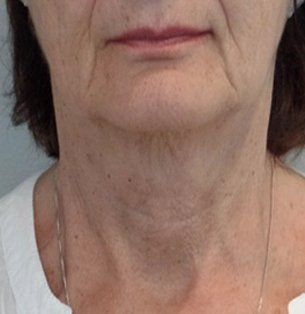 Neck treatment after
