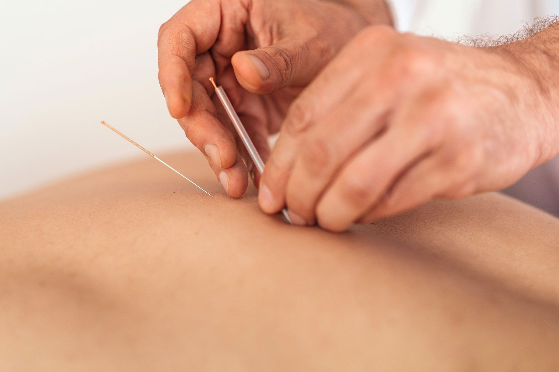 Acupuncture Treatment — Plympton, SA — Aaron Slape Acupuncturist