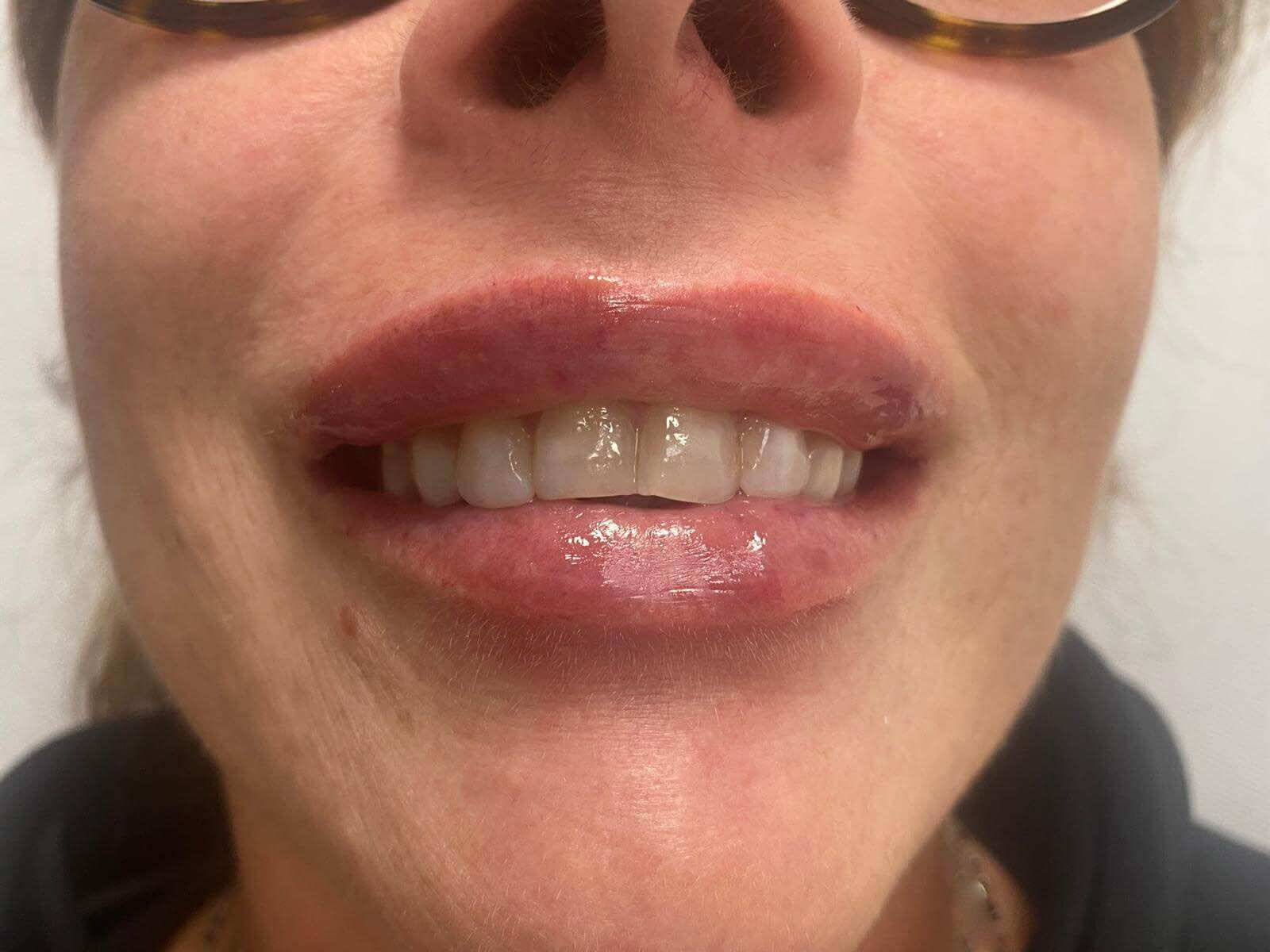 gummy smile dopo l'intervento
