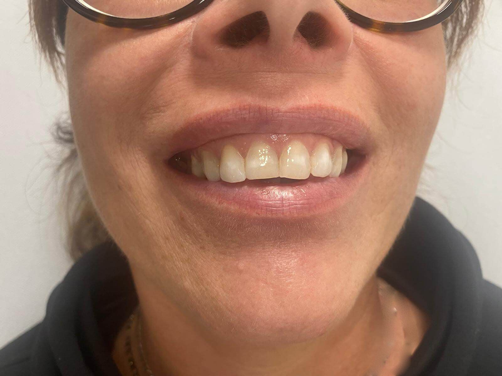 gummy smile  prima e dopo l'intervento