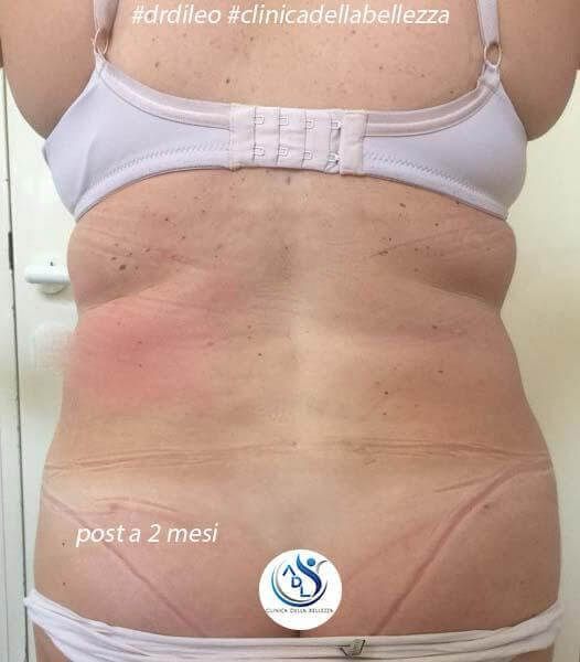 Viene mostrata la schiena di una donna con le parole post a 2 mes in basso