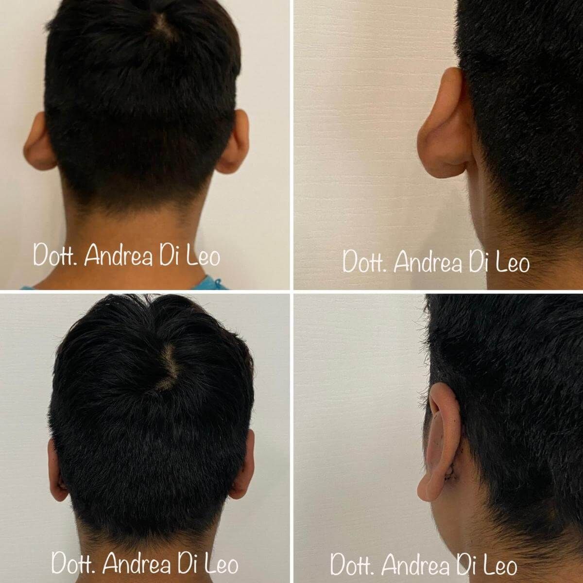 Un collage di quattro foto delle orecchie di un uomo scattate dal dott. andrea di leo