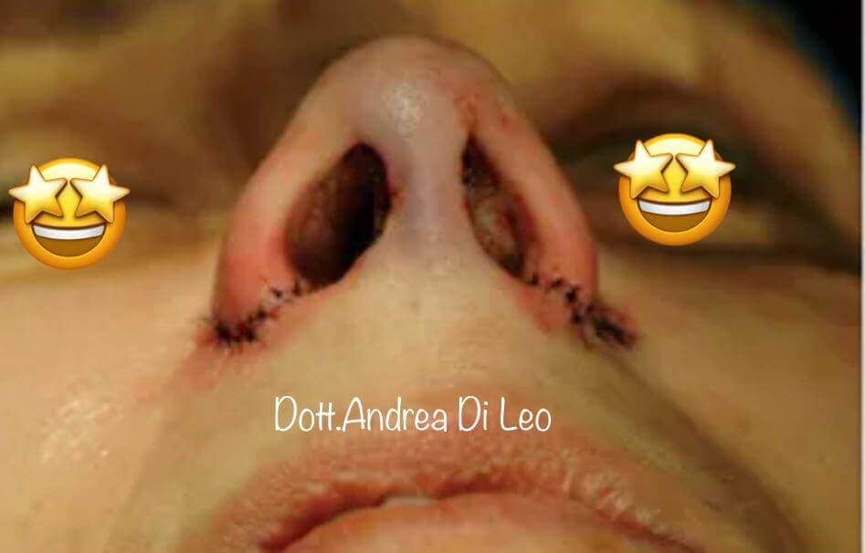 Un primo piano del naso di una persona con due faccine sorridenti su di esso