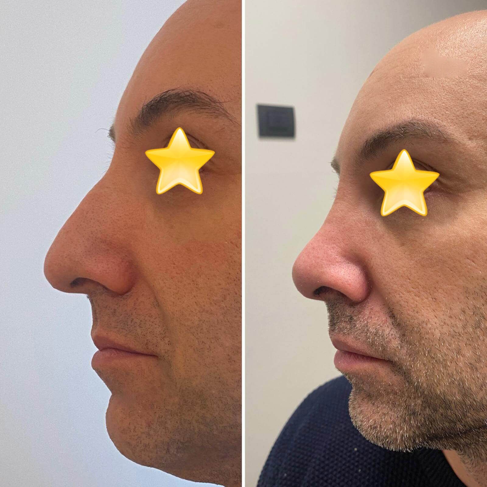 Una foto prima e dopo del naso di un uomo