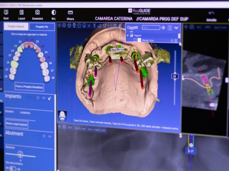 Software di pianificazione implantare dentale che mostra un modello 3D della mandibola con impianti e scansioni su un'interfaccia blu.