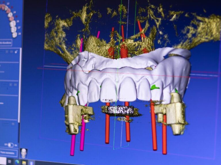 Modello 3D per la pianificazione di impianti dentali con mascella superiore, impianti e marcatori guida rossi su sfondo blu.
